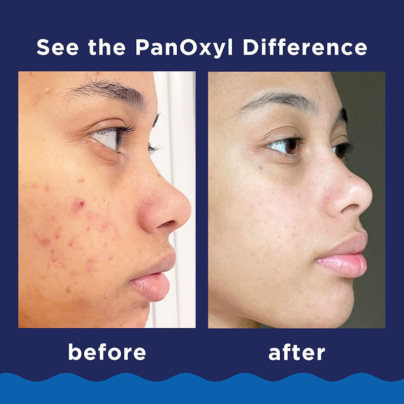PanOxyl Acne Foaming Wash 10% Benzoyl Peroxide — 156g