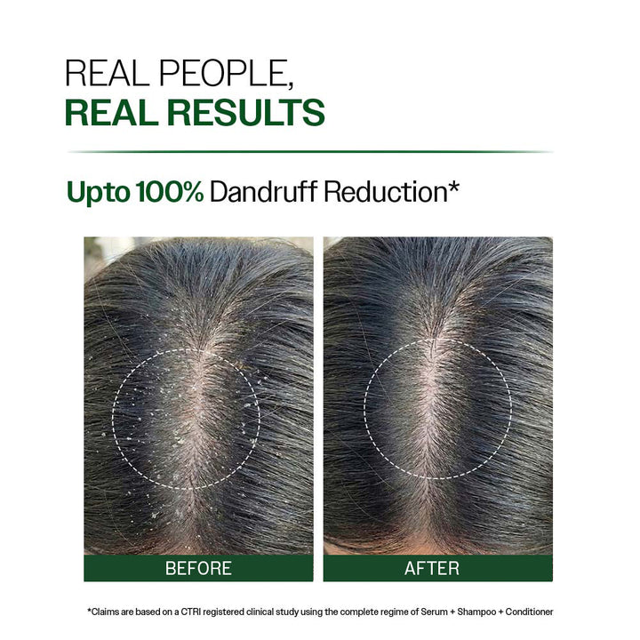 Bare Anatomy Anti-Dandruff Shampoo – Up to 100% Dandruff Reduction | 250ml